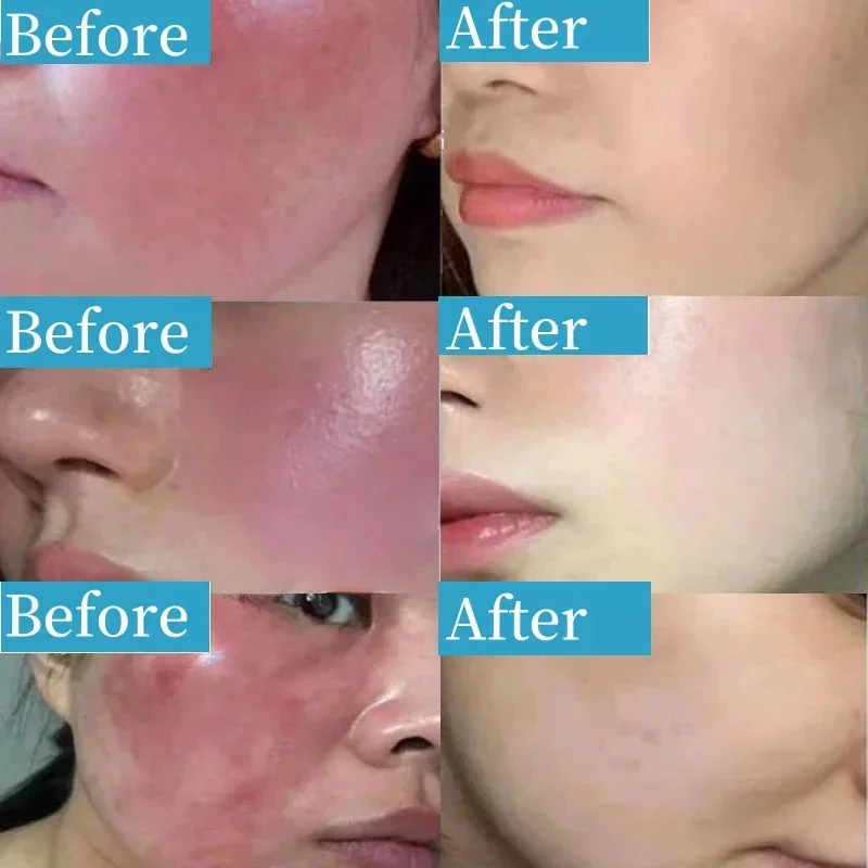 7X Facial Redness Soothing Serum Instant Rosacea Red Blood Vein Treatment Improve Sensitive Skin Barrier Repair Korean Cosmetics - Image 2
