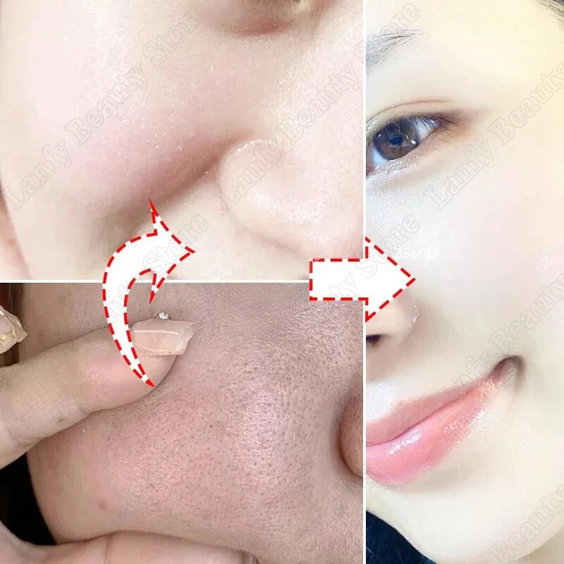 Salicylic Acid Pore Clearing Cream Shrink Pores Remove Blackheads Acne Brighten Moisturizing Smooth Skin Care Korean Products - Image 2